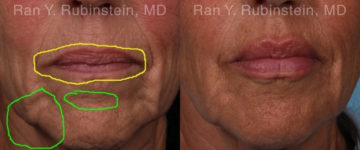 Lip Fillers Before and After Photos in Montvale, NJ, Patient 19037