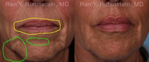 Lip Fillers Before and After Photos in Montvale, NJ, Patient 19037