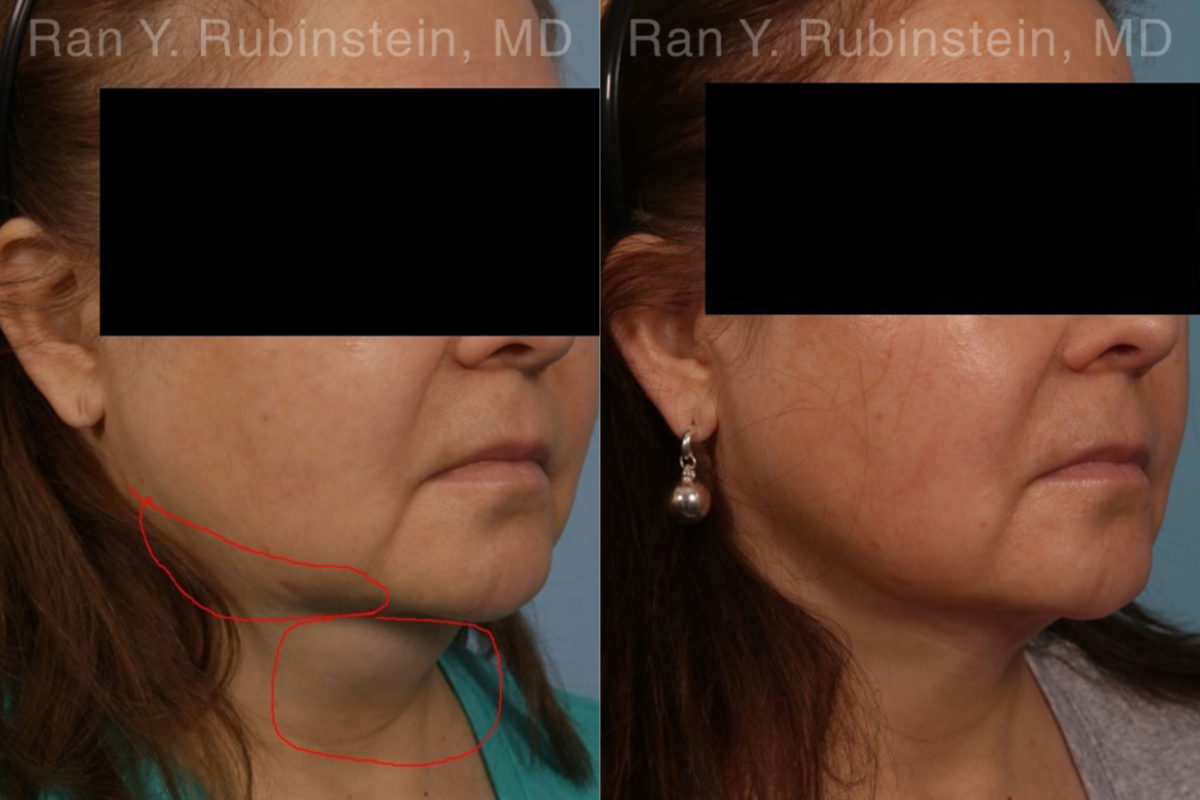 Laser Lift Precision Tx Before and After Photos in Montvale, NJ, Patient 19204