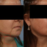 Laser Lift Precision Tx Before and After Photos in Montvale, NJ, Patient 19204