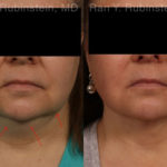 Laser Lift Precision Tx Before and After Photos in Montvale, NJ, Patient 19204