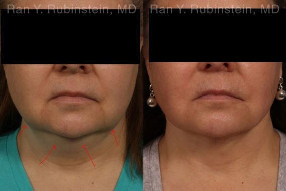 Laser Lift Precision Tx Before and After Photos in Montvale, NJ, Patient 19204