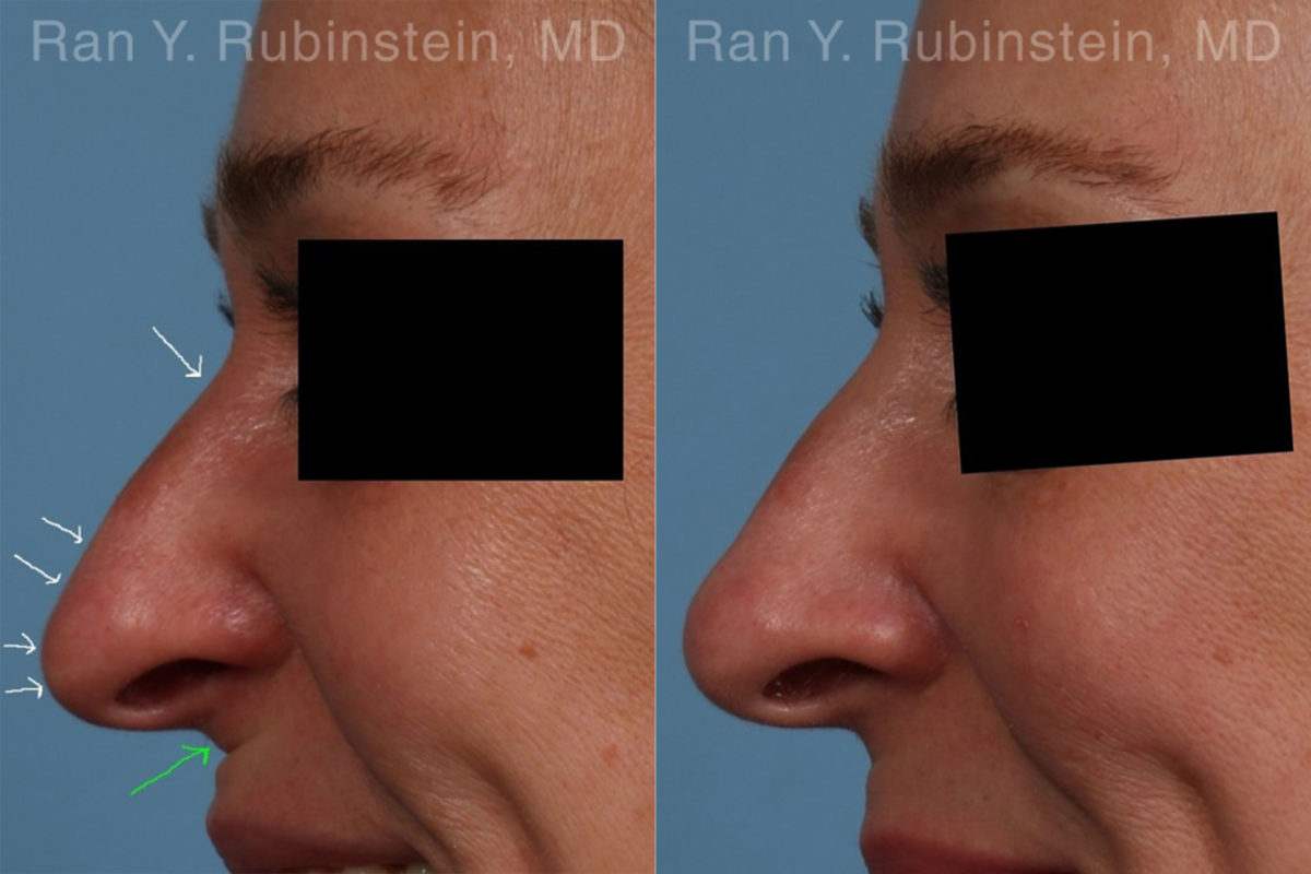 Non-Surgical Rhinoplasty Before and After Photos in Montvale, NJ, Patient 19263