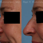 Non-Surgical Rhinoplasty Before and After Photos in Montvale, NJ, Patient 19263
