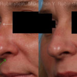 Non-Surgical Rhinoplasty Before and After Photos in Montvale, NJ, Patient 19263