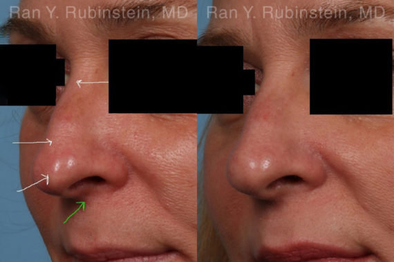 Non-Surgical Rhinoplasty Before and After Photos in Montvale, NJ, Patient 19263