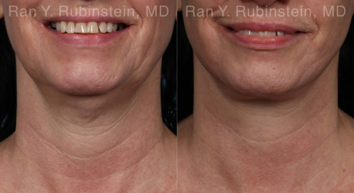 Face lift & Neck lift Before and After Photos in Montvale, NJ, Patient 19365