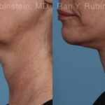 Face lift & Neck lift Before and After Photos in Montvale, NJ, Patient 19365