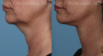 Face lift & Neck lift Before and After Photos in Montvale, NJ, Patient 19365