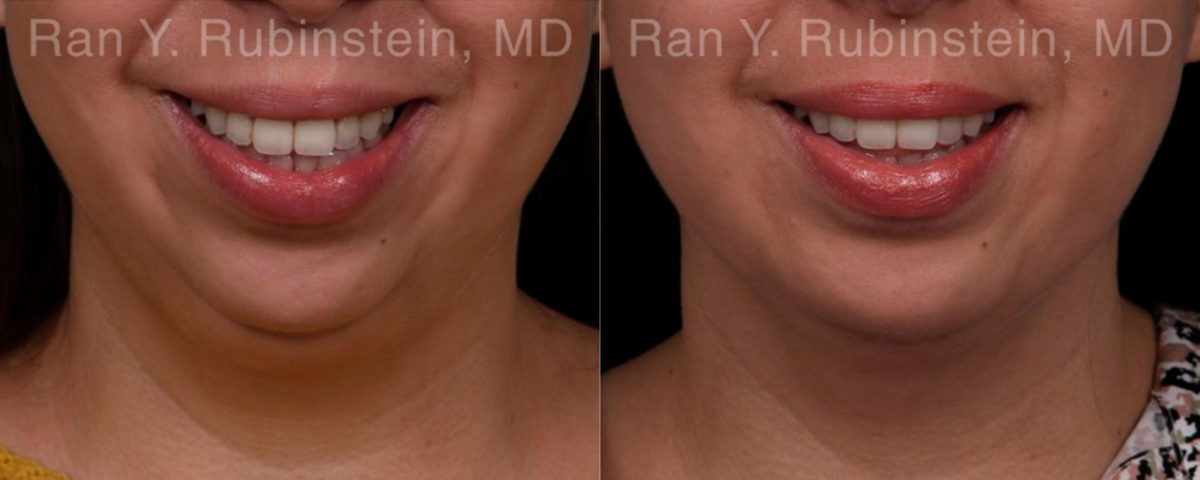 Chin Augmentation Before and After Photos in Montvale, NJ, Patient 19433