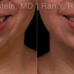Chin Augmentation Before and After Photos in Montvale, NJ, Patient 19433