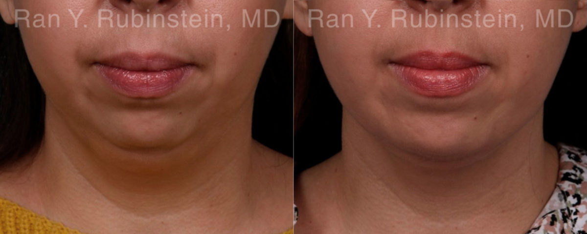 Chin Augmentation Before and After Photos in Montvale, NJ, Patient 19433