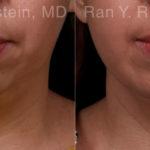 Chin Augmentation Before and After Photos in Montvale, NJ, Patient 19433