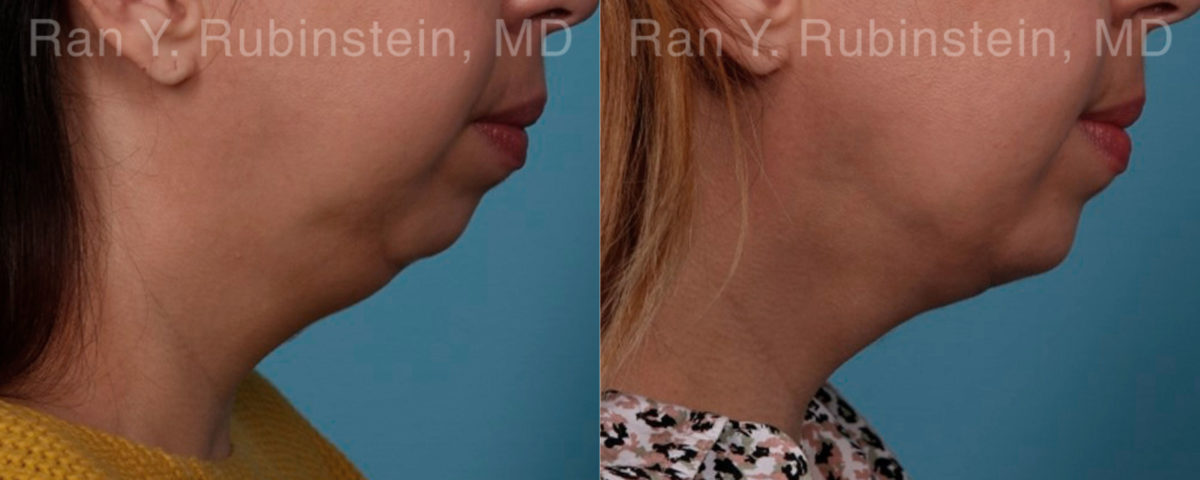 Chin Augmentation Before and After Photos in Montvale, NJ, Patient 19433