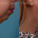 Chin Augmentation Before and After Photos in Montvale, NJ, Patient 19433