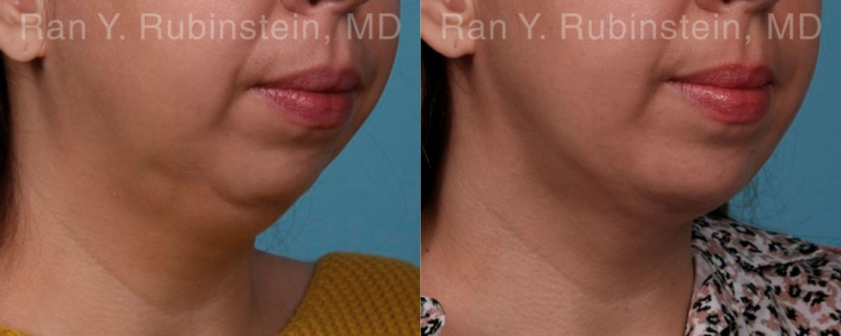 Chin Augmentation Before and After Photos in Montvale, NJ, Patient 19433