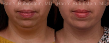 Chin Augmentation Before and After Photos in Montvale, NJ, Patient 19433