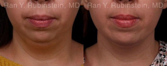 Chin Augmentation Before and After Photos in Montvale, NJ, Patient 19433