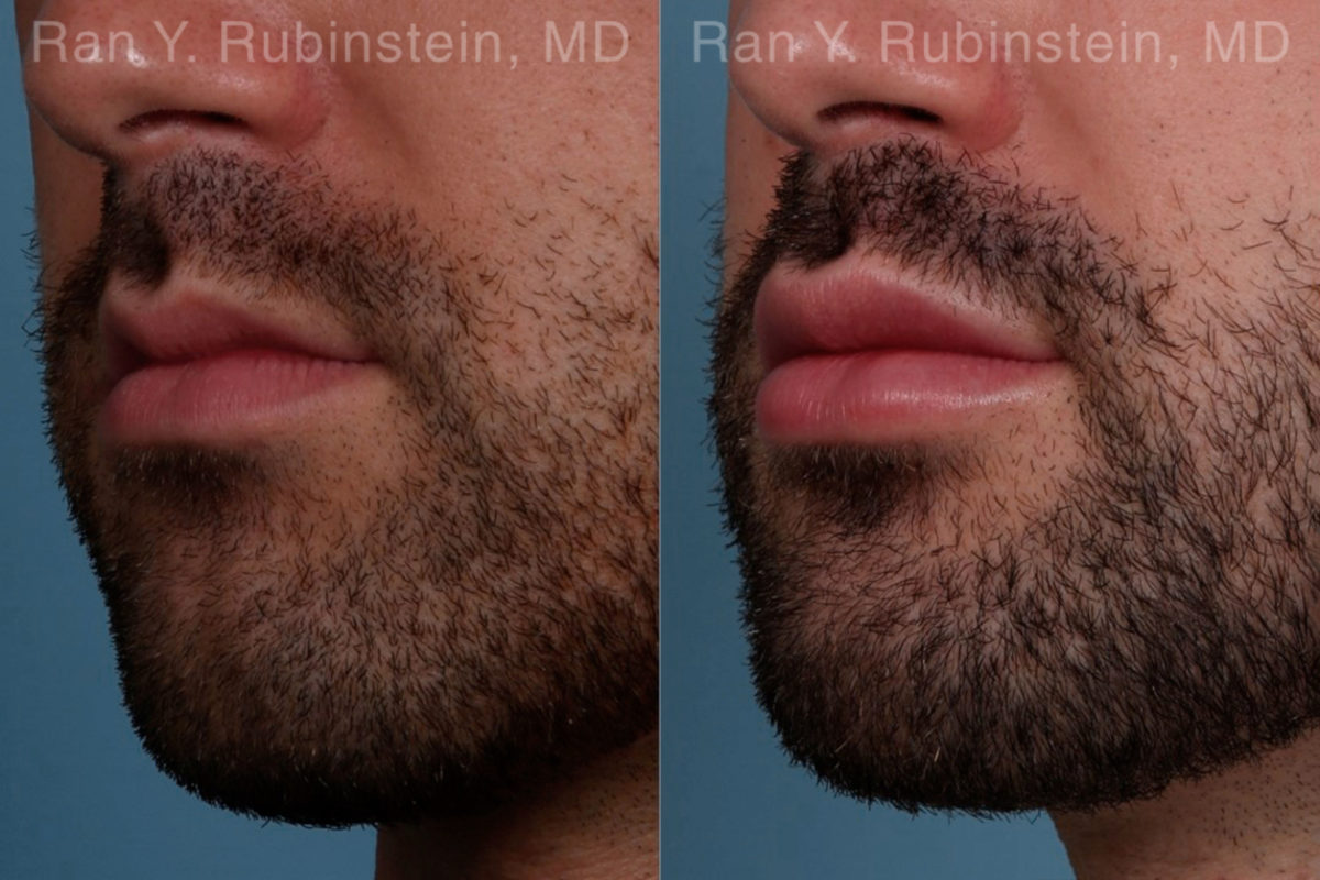 Lip Fillers Before and After Photos in Montvale, NJ, Patient 19484