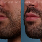 Lip Fillers Before and After Photos in Montvale, NJ, Patient 19484