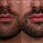 Lip Fillers Before and After Photos in Montvale, NJ, Patient 19484
