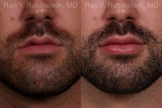 Lip Fillers Before and After Photos in Montvale, NJ, Patient 19484