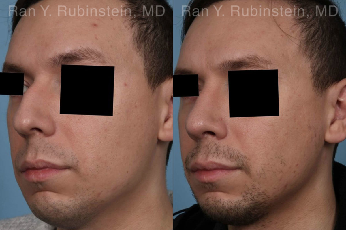 Rhinoplasty Before and After Photos in Montvale, NJ, Patient 19601