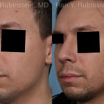 Rhinoplasty Before and After Photos in Montvale, NJ, Patient 19601