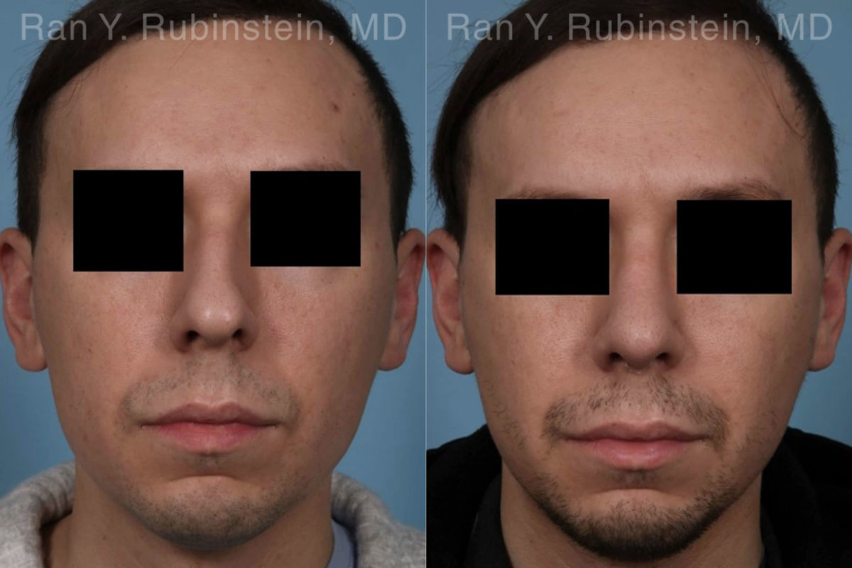 Rhinoplasty Before and After Photos in Montvale, NJ, Patient 19601