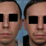 Rhinoplasty Before and After Photos in Montvale, NJ, Patient 19601
