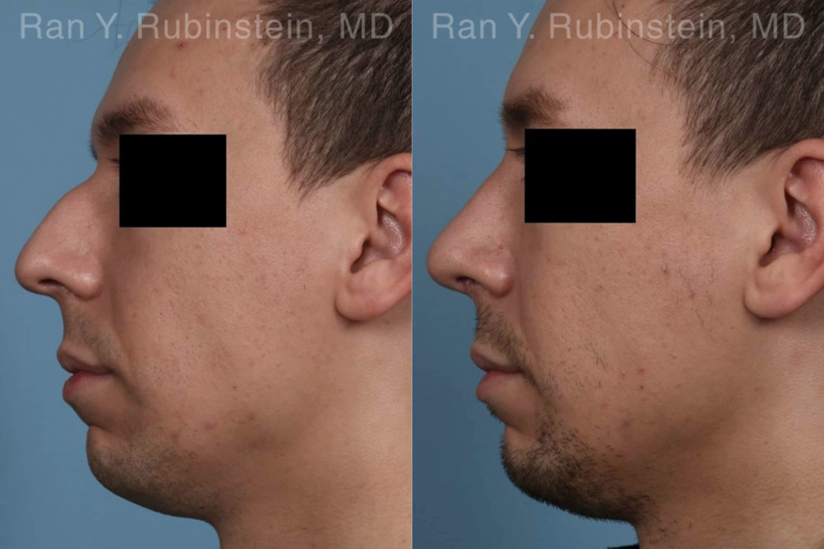 Rhinoplasty Before and After Photos in Montvale, NJ, Patient 19601
