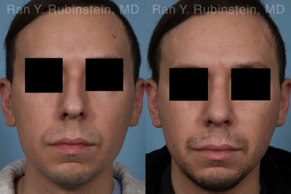 Rhinoplasty Before and After Photos in Montvale, NJ, Patient 19601