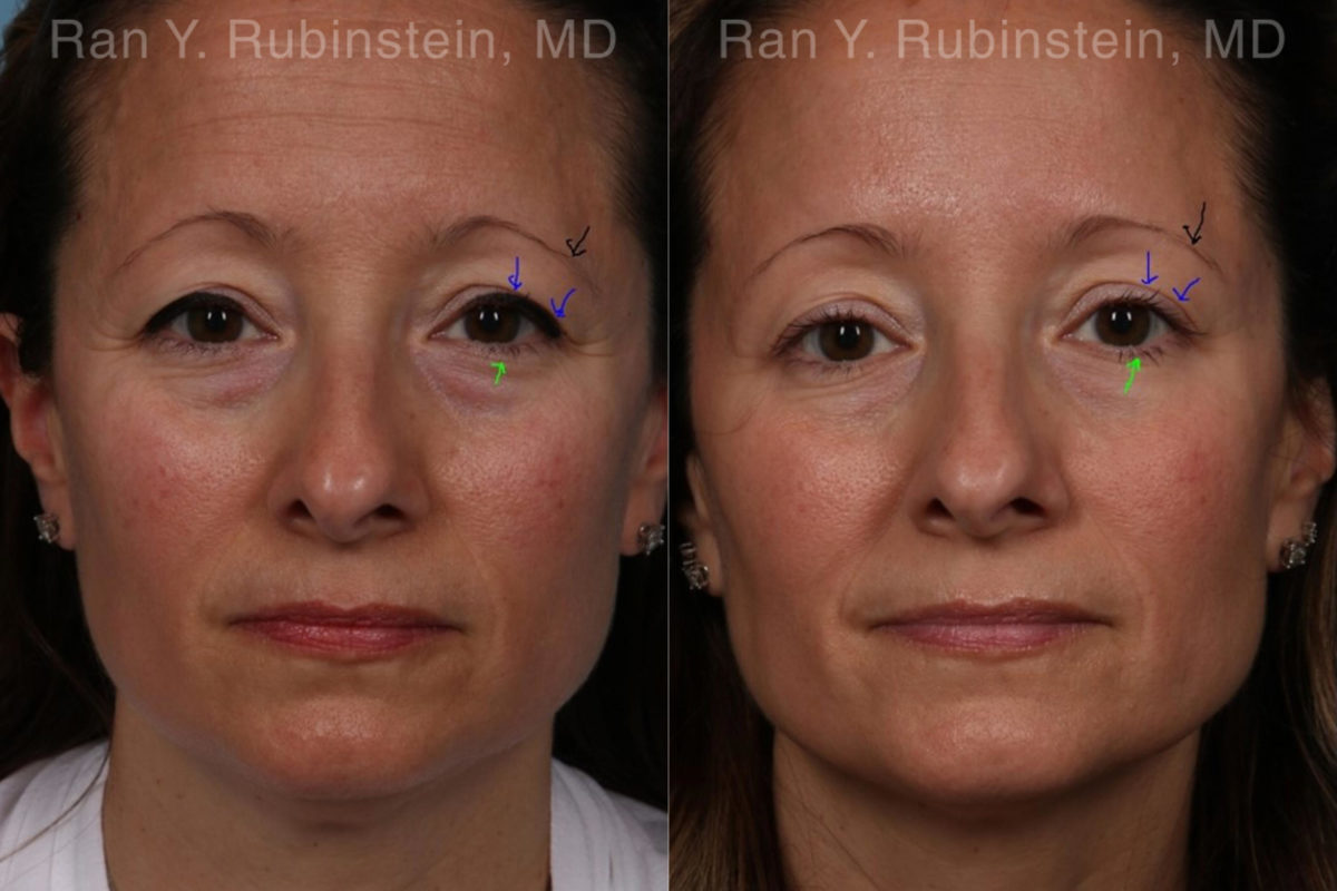 Botox Before and After Photos in Montvale, NJ, Patient 19722