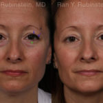 Botox Before and After Photos in Montvale, NJ, Patient 19722