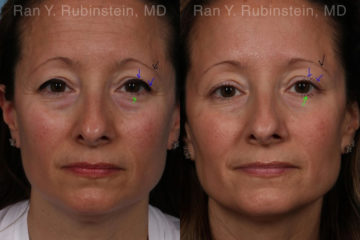 Botox Before and After Photos in Montvale, NJ, Patient 19722