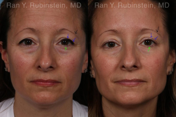 Botox Before and After Photos in Montvale, NJ, Patient 19722