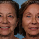 Brow Lift Before and After Photos in Montvale, NJ, Patient 19743