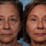 Brow Lift Before and After Photos in Montvale, NJ, Patient 19743