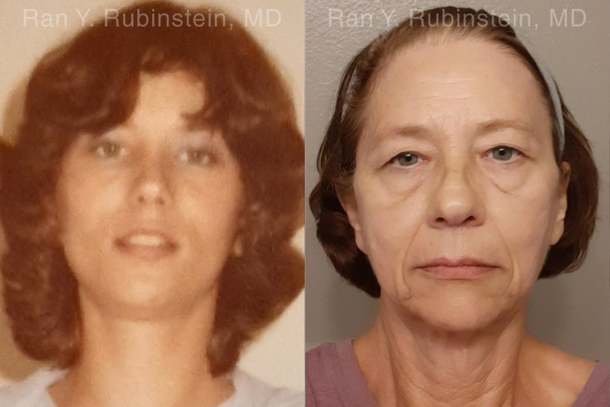 Brow Lift Before and After Photos in Montvale, NJ, Patient 19743