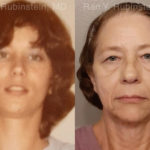 Brow Lift Before and After Photos in Montvale, NJ, Patient 19743