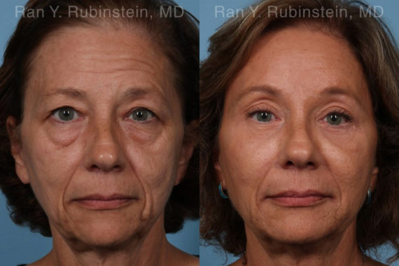Brow Lift Before and After Photos in Montvale, NJ, Patient 19743