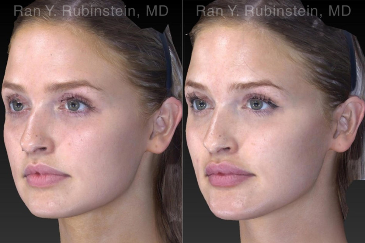Chin Filler Before and After Photos in Montvale, NJ, Patient 19839
