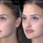 Chin Filler Before and After Photos in Montvale, NJ, Patient 19839