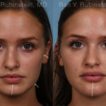Chin Filler Before and After Photos in Montvale, NJ, Patient 19839