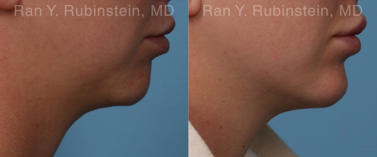 Chin Filler Before and After Photos in Montvale, NJ, Patient 19846