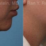 Chin Filler Before and After Photos in Montvale, NJ, Patient 19846