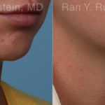 Chin Filler Before and After Photos in Montvale, NJ, Patient 19846