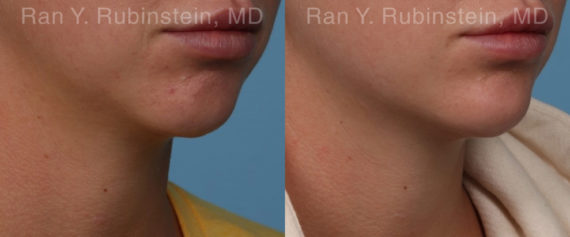 Chin Filler Before and After Photos in Montvale, NJ, Patient 19846