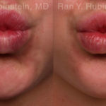 Botox Before and After Photos in Montvale, NJ, Patient 19853