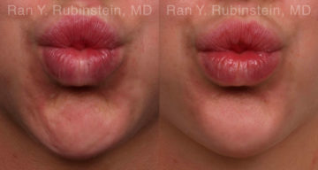 Botox Before and After Photos in Montvale, NJ, Patient 19853